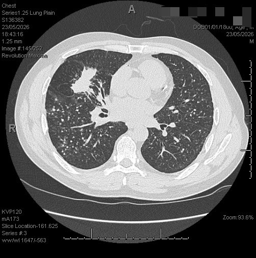 itsManar01's tweet photo. مريض أجنبي من الطوارئ يشتكي ألم في صدره من الجهة اليمنى ، طلب له الطبيب العام chest x ray و ما كان التشخيص واضح  ، طلب له استشاري الصدر فحص CT CHEST WITH CONTRAST عشان يتأكد ، وهذي بعض الصور 
وش تشخيصكم ؟ https://t.co/ATrlVsR42q