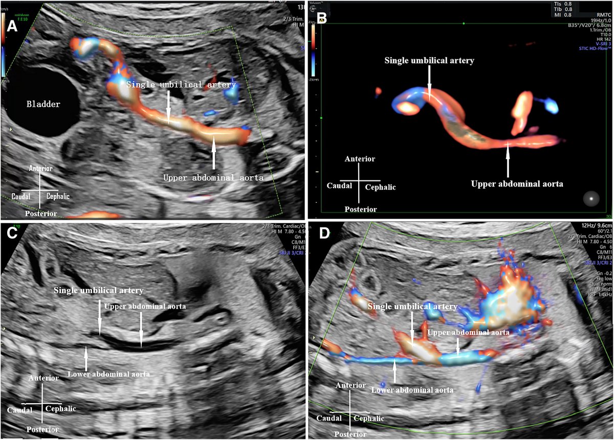 AJOG_thegray's tweet photo. AJOG Images in Obstetrics: Prenatal diagnosis of a single umbilical artery originating from a persistent vitelline artery - Type II single umbilical artery originates from superior mesenteric artery
https://t.co/4F2xZqJnDV https://t.co/nVe7TxWXwn