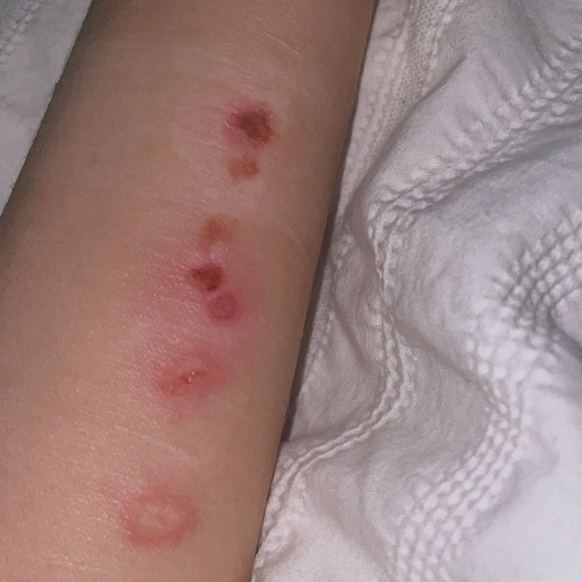 ellismi8's tweet photo. cigarette burns 💗 

#shtwt #burn #sh #masochist #cigburn https://t.co/ZHrLveDRsF