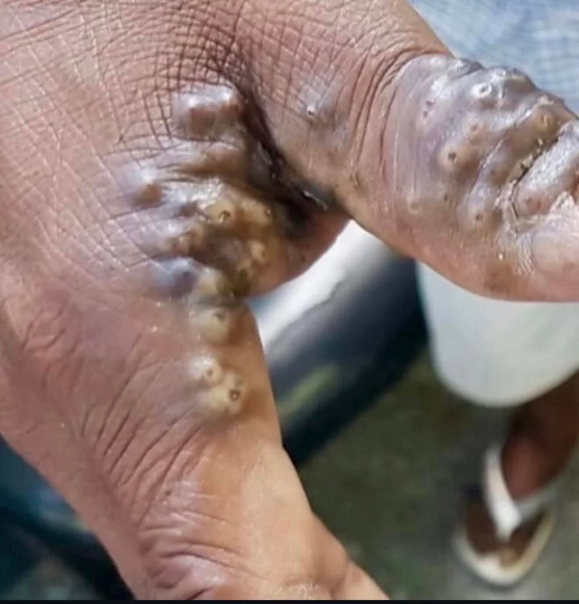albertoortegana's tweet photo. A 54-year-old male patient seeks medical attention for intense pain and itching in his hands, with difficulty manipulating objects. He reports progressive worsening over the past few weeks. Physical examination reveals multiple lesions on his hands, periungual and interdigital.
Diagnosis?