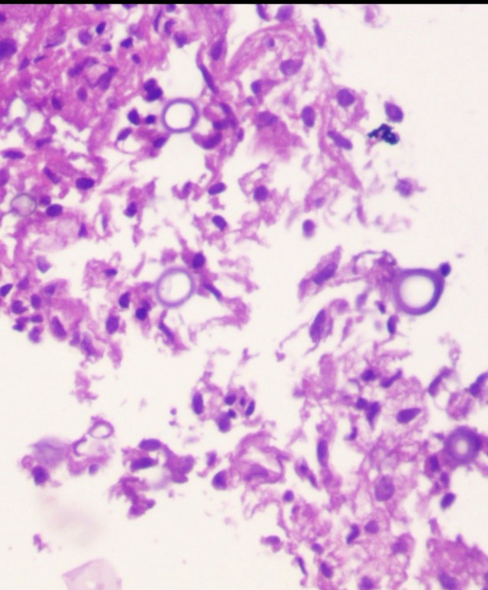cherry748's tweet photo. @smlungpathguy @pepeheffernan @GaryProcop @TristanRutland7 @Gleason4plus5 @SansanoValero @edusqo @pembeoltulu @JMGardnerMD @slusagar Mass lesion left lower lobe lung https://t.co/drjmHB8cWI