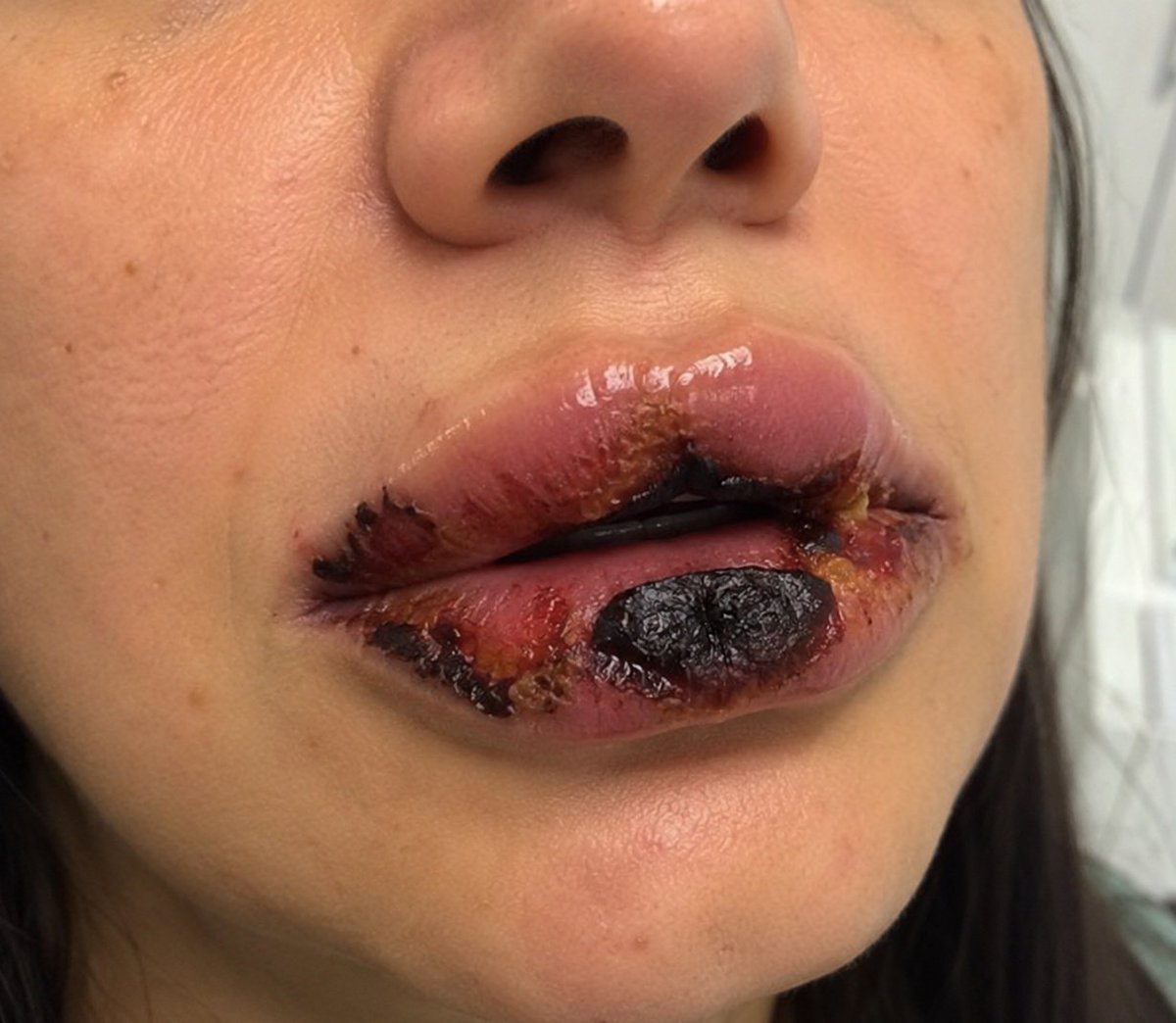 IhabFathiSulima's tweet photo. A 27-year-old woman developed severe pain,  within hours after a cosmetic filler injection.
What has seriously Went Wrong and what is the outcome? https://t.co/fLYRTB5caF