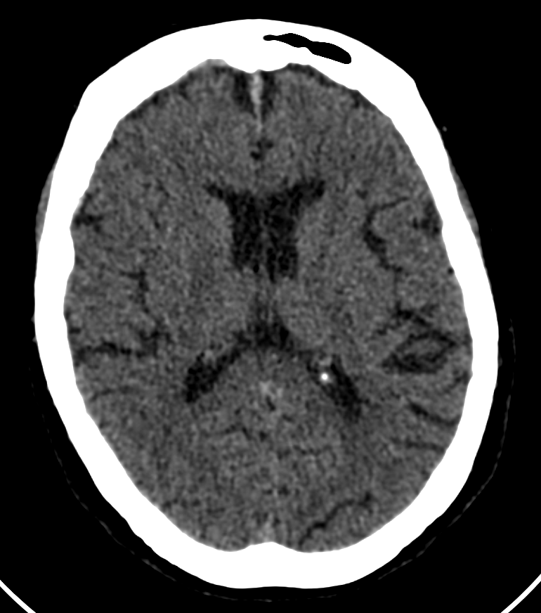 Rad_Bits's tweet photo. Quiz:260: Trauma. Finding?

#meded #radiology #neuro #foamed #radres https://t.co/2oWJVlVFM0