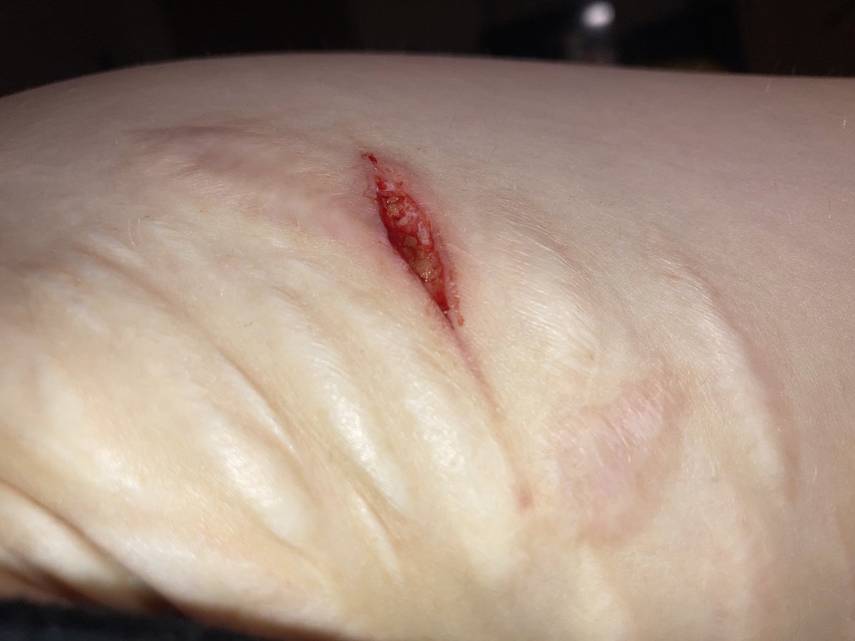 cascadingcolors's tweet photo. #slittwt i didnt bother taking pictures of my relapse a week or so ago bcz my flatmate interrupted me And i kept it #shallowaf but actually I like how my legs look when I obsessively pick and anf pull the scabs off my horribly crusty legs https://t.co/vvxTUC6c0s