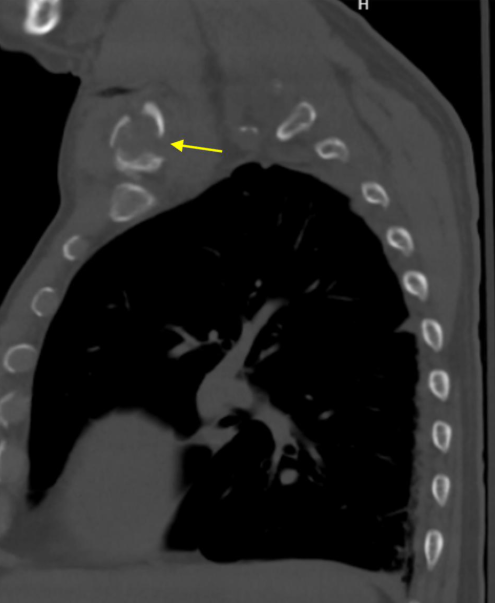 jbjs's tweet photo. "Clavicular Distraction Osteoplasty With Sternoclavicular Reconstruction for a Medial Clavicle Fracture" by Huaco et al.

Read the full article 👉 https://t.co/jhPpJvDzUj

#JBJS https://t.co/s7kwDpkbp1