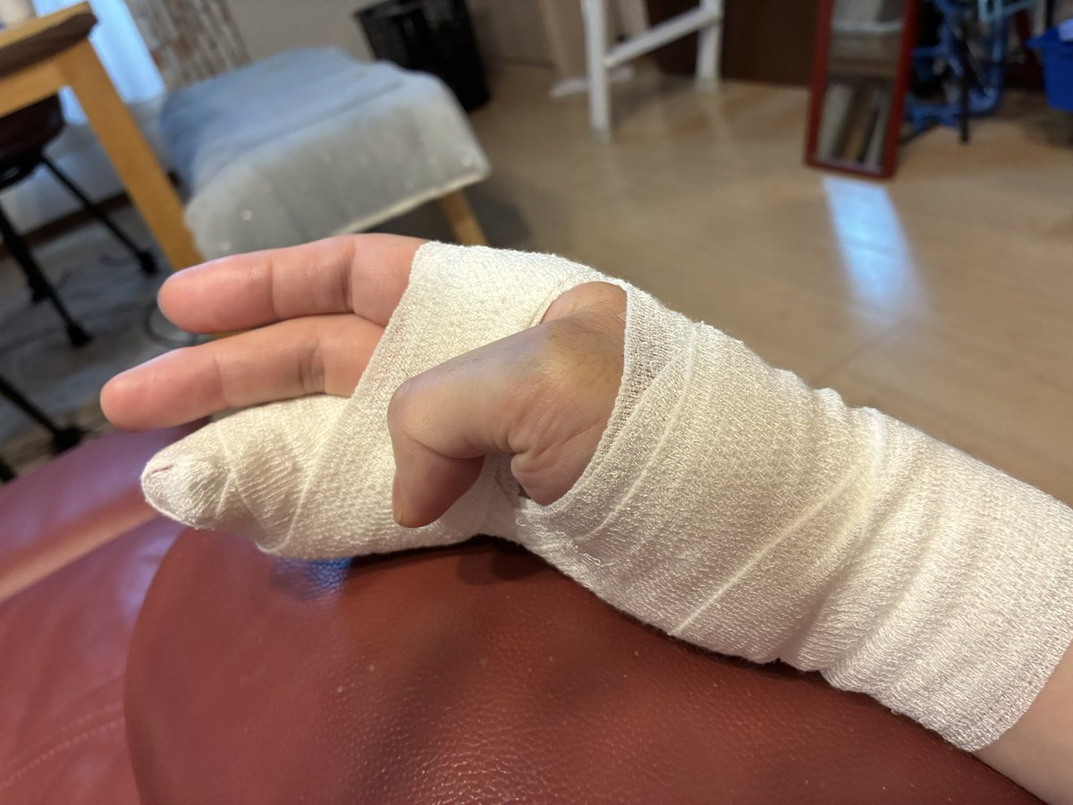 Shogo_Beppu's tweet photo. やってしまった右手指骨折
暫くダーツは無理ですね
お箸も持てないし、不便っす💧 https://t.co/Z2JQJnn6iZ