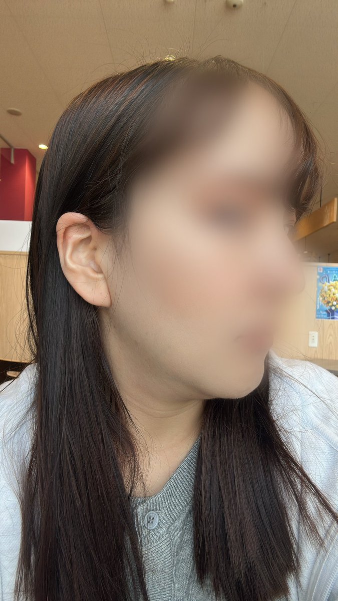 ft9575's tweet photo. @SaekimJP セギム整形外科にて骨切りして半年経ちました。ずっと不安だったのも落ち着き、傷跡も落ち着いてきたのと先生がおっしゃってた通り浮腫が半年経ったら消えました！浮腫も消えたおかげか顔が顔がなお小さくなりました。
他の施術も検討していこうと思います。
本当に有難うございました🙏 https://t.co/oGiYJ6ujnX