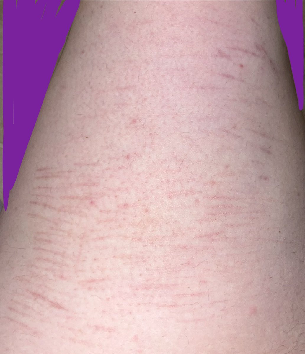 r1ddlem4n's tweet photo. I’ve been clean for 20 days…and this is how my thighs look :3 https://t.co/bpV58b5g1q
