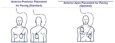 keisuke_np's tweet photo. 経皮ペーシング(TCP)を開始する際、私はほぼ全例Anterior-Posterior Placement for Pacing(Standard)を選択しますが、メンバーはOptionalしか見た事ないんだろう、怪訝な顔をされ、更にひどい看護師はわざわざ剥がしてOptionalにされる。泣きたい。 https://t.co/L38uBqDLN1