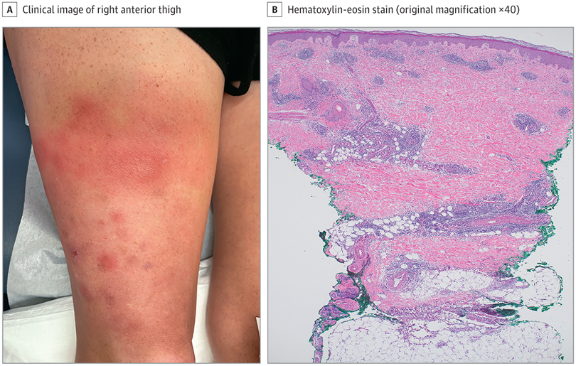 JAMADerm's tweet photo. A woman in her 40s with a medical history of complex regional pain syndrome presented to the dermatology department for evaluation of a pruritic recurrent rash on her right anterior thigh that started 1 month prior. 

Take the Clinical Challenge: https://t.co/9fNq9wZBm9 https://t.co/kqMvqX67yL