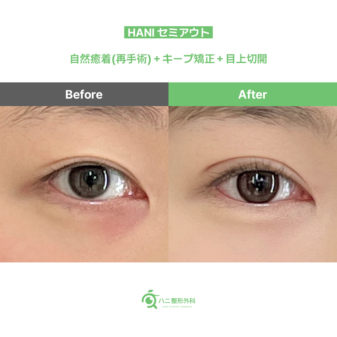 hanips_jp's tweet photo. 𝐇𝐀𝐍𝐈 𝐁𝐞𝐟𝐨𝐫𝐞 & 𝐀𝐟𝐭𝐞𝐫💚きれいなセミアウト💚

目尻の二重線が薄いので
鮮明なセミアウトを作りたいです🙏
───────────
リアルハニ
💟自然癒着(再)+キープ矯正
💟目上切開
💟１か月目
───────────
📌ʟɪɴᴇ：https://t.co/fQ9yg0nHC2
📌日本語対応可能
📌保証期間：１年
📌整形証明書発行
📌局所麻酔+睡眠麻酔