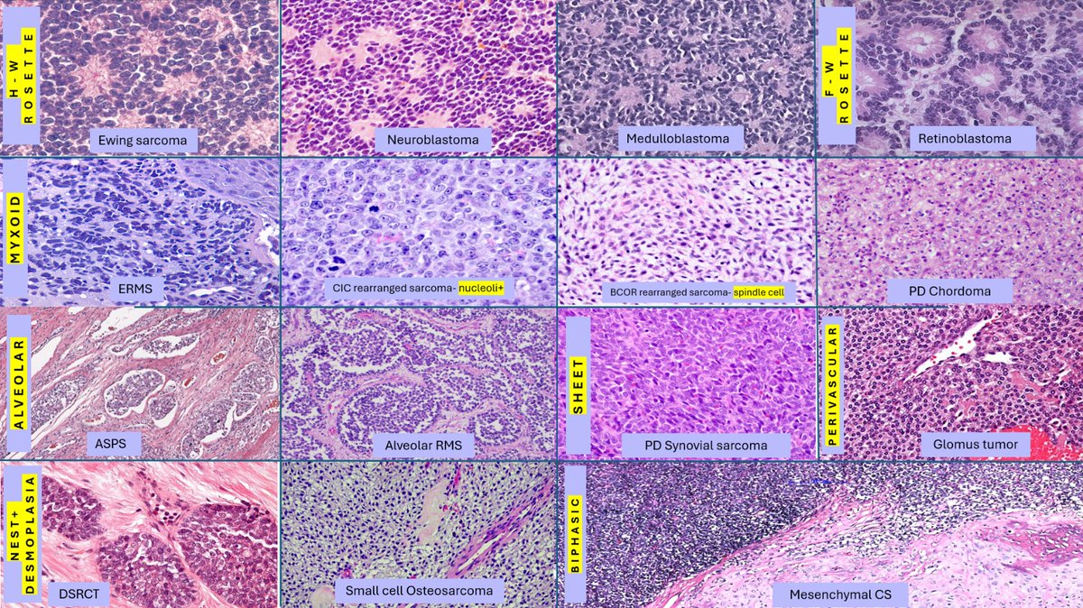 pathognosis22's tweet photo. Differentials of spindle, epithelioid, myxoid and small round blue cell tumors in one post. Pattern based approach. #BST #NEETSS #NEET #soft_tissue #OC #pathology #pathognosis #histopath #histopathology https://t.co/quOGsyzSoB