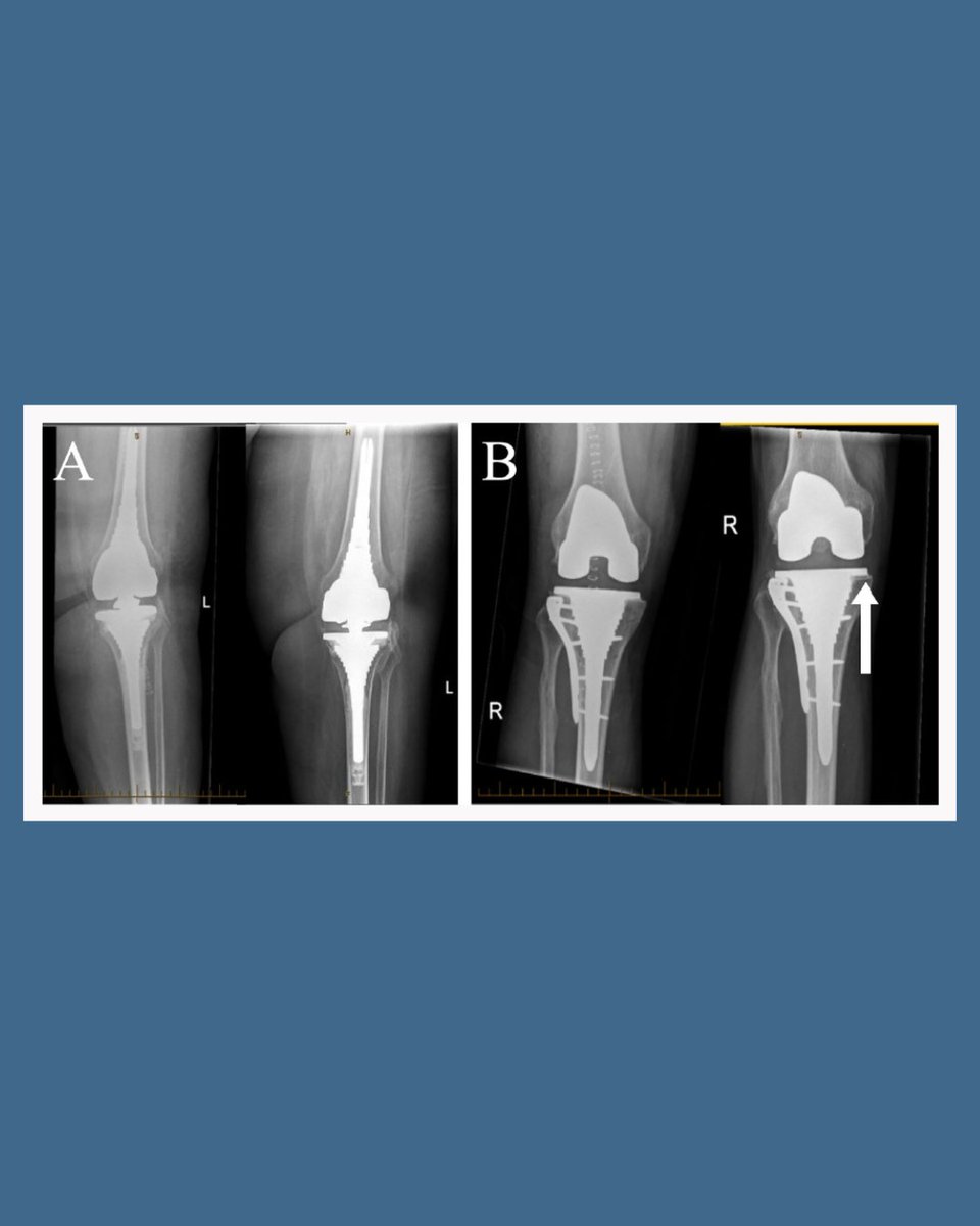BoneJointOpen's tweet photo. Total knee arthroplasty with metaphyseal sleeves has a role in selected elderly patients with tibial plateau fractures (TPFs) not amenable to reconstruction. It addresses fixation failure in TPF &amp; enables early mobilization with acceptable outcomes.

#BJO

https://t.co/dc4HYSAkuI https://t.co/UoDA3Gm27Q