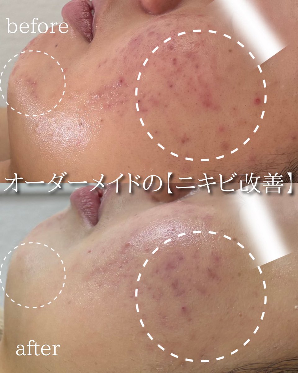 UneLimit39's tweet photo. Unelimit原宿店 まやです🔥

【オーダーメイドニキビ改善】

お客様一人一人に合ったメニューやホームケア。
私たちスキンケアアドバイザーがしっかりと肌質改善をサポートさせていただきます♪♪

フェイシャルエステ初めての方や、メニューで迷われている方
ぜひぜひオーダーメイドメニューをお選びください✨

 #肌質改善 #肌管理 #肌荒れ #スキンケア #エステサロン #ピーリング #ニキビ