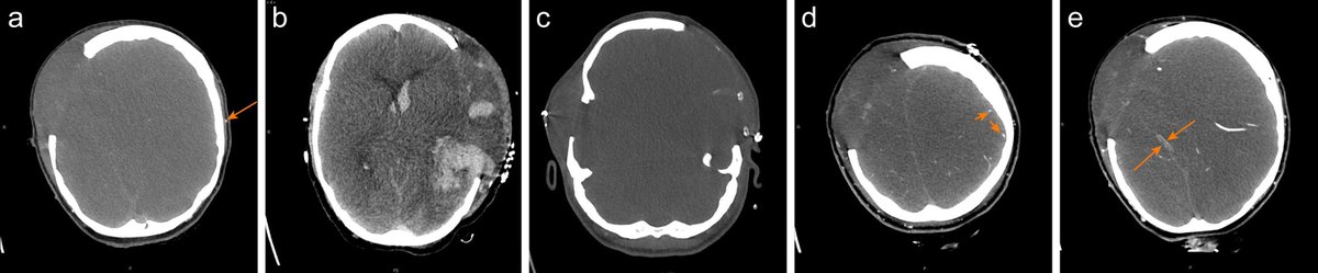 BJAJournals's tweet photo. Make sure you don't miss this excellent new #BJAEd article on the Diagnosis of Death using Neurological Criteria: https://t.co/lSffX4P0zZ https://t.co/f5BtE9WdYN