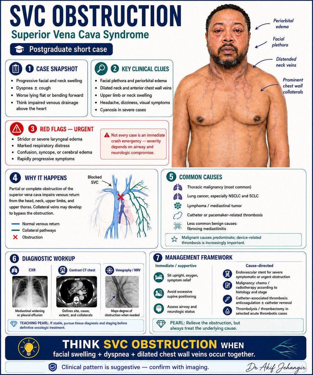 pgMedicine's tweet photo. Superior Vena Cava Syndrome https://t.co/8TVO9Vppa0