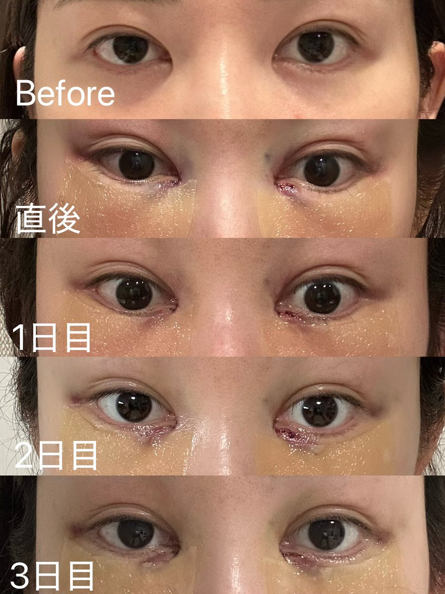 biyouchansn's tweet photo. @kshclinic 
SH整形外科で目頭切開とフィラーを受けてきました🥰ゴルゴ線が気になっていたので相談したところ皮膚の段差？によって線ができてしまうので、目頭切開で段差をなくすことによってゴルゴ線が改善されるとのことでした。完全に消そうとすると切開の範囲を広くしないといけなく、、、 https://t.co/O0VHQMJ55r