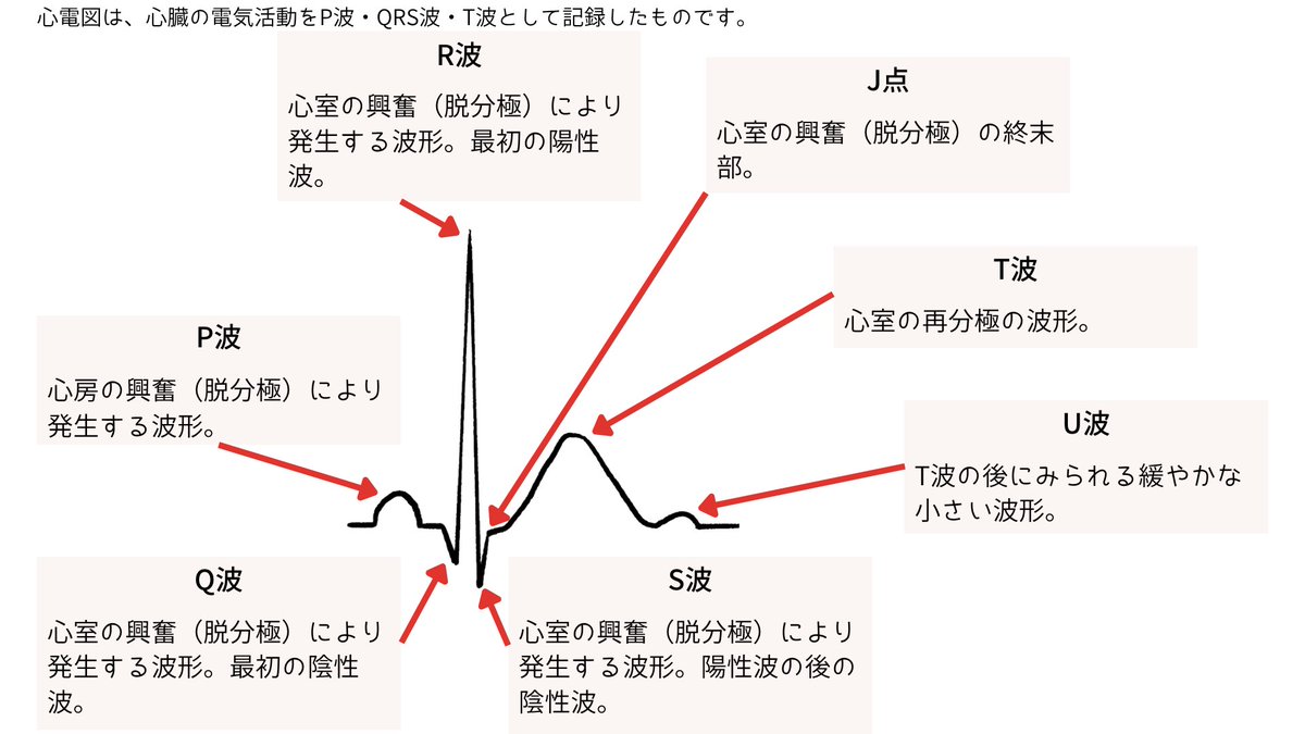 ecgkuma's tweet photo. 心電図が読める人と、
読めない人の差は一つです。

波形を「形」で見ているか、
「電気の流れ」で見ているか。

P波、QRS波、T波。
名前を覚えるだけでは、
本質は見えてきません。

なぜなら心電図は、
刺激伝導系のどこで、
何が起きているかを
記録したものだからです。

この基本波形を
最初に理解しておく理由は明確です。

心電図異常の多くは、
「正常な通過ルートの
どこが崩れたか」
の表れだからです。

まずP波。

心房の脱分極。
洞結節から始まった電気が、
心房全体へ広がる瞬間です。

ここで見るべきは3つ。

① 起源は正常か
② 形は整っているか
③ 大きさは適切か

明らかなP波が見えず、
RR間隔が不整なら
心房細動を考えます。

鋸歯状の波形が見えれば
心房粗動を疑います。

Ⅱ誘導でP波が陰性なら、
洞結節以外の起源を疑います。

また心房負荷も
評価できることがあります。

P波が高く尖るなら右房負荷。
肺高血圧、慢性肺疾患など。

幅広く二峰性になるなら左房負荷。
僧帽弁疾患など。

P波は、
「出発点」と
「心房の状態」を
同時に映しています。

次にPQ（PR）間隔。

房室結節で電気が
一度減速している時間です。

ここが延びれば
房室伝導の遅れを考えます。
代表が1度房室ブロックです。

短ければ、
副伝導路などを考えます。

心房と心室が
順番に動くための、
大切な待ち時間です。

QRS波。

心室の脱分極です。

ヒス束から脚を通り、
プルキンエ線維を介して
一気に広がる電気。

幅が広がるということは、
どこかで伝導が遅れている、
あるいは通常とは異なる
伝わり方をしているということです。

脚ブロック、WPW症候群など

「広い」という事実の裏には、
必ず構造的・電気的な理由があります。

J点。

心室脱分極の終わりです。
ここがST評価の
スタート地点になります。

ST部分。

これは波ではありません。

心室全体が
すでに興奮し終わっている、
本来は等電位である時間です。

だからこそ、
ズレることに意味があります。

STが上がれば、
急性心筋梗塞を含む
ST上昇の原因を考えます。

STが下がれば、
虚血や負荷を考えます。

動かないはずの場所が動いている。
それが異常のサインです。

T波。

心室の再分極です。

尖れば高カリウム血症。
陰転すれば虚血や、
心肥大に伴うストレインを考えます。

形の左右対称性や深さも、
心筋の状態を反映します。

U波。

T波のあとに見られる
小さな波です。

低カリウム血症で
目立つことがあります。

小さな波ですが、
電解質異常を教えてくれる
ヒントになります。

ここまで整理すると、
すべてが一本の線でつながります。

洞結節が乱れればP波が変わる。
心房に負荷がかかればP波が変わる。
房室伝導が乱れればPQが変わる。
脚や心室内伝導が乱れればQRSが変わる。
虚血が起きればST・Tが変わる。
電解質が乱れればT・Uが変わる。

すべては、
刺激伝導系と
心筋の状態の反映です。

「この波形は、
どこで何が起きているのか？」

それを言語化できるかどうか。

そこまで理解できた瞬間、
心電図は一気に
分かり始めます。

読むとは、
電気の動きを
頭の中で再生すること。

波形を見るのではない。
心臓の中を透視する。

ここができれば、
異常は怖くなくなります。