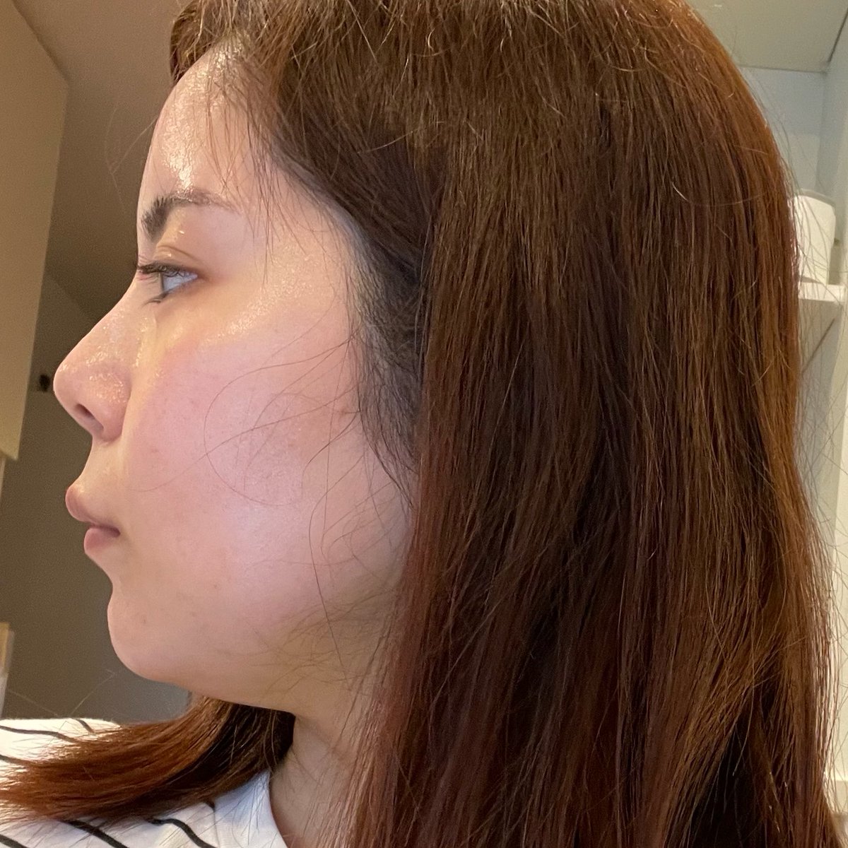 biyou_onnie's tweet photo. 顎下脂肪吸引から5年後レポ🌱

「時間経ったら弛むか戻るかも…」って不安だったけど、5年経った今もフェイスライン綺麗！あの時踏み切って本当に良かったと思ってる🥺

価格は10万円。執刀医はリプライした方に送ります🇯🇵

←Before　　　　　　　　　→After https://t.co/6wR0lG2wwQ