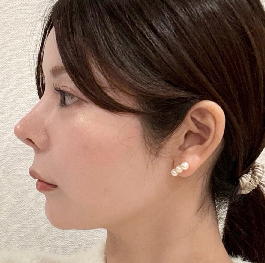 biyou_onnie's tweet photo. 顎下脂肪吸引から5年後レポ🌱

「時間経ったら弛むか戻るかも…」って不安だったけど、5年経った今もフェイスライン綺麗！あの時踏み切って本当に良かったと思ってる🥺

価格は10万円。執刀医はリプライした方に送ります🇯🇵

←Before　　　　　　　　　→After https://t.co/6wR0lG2wwQ