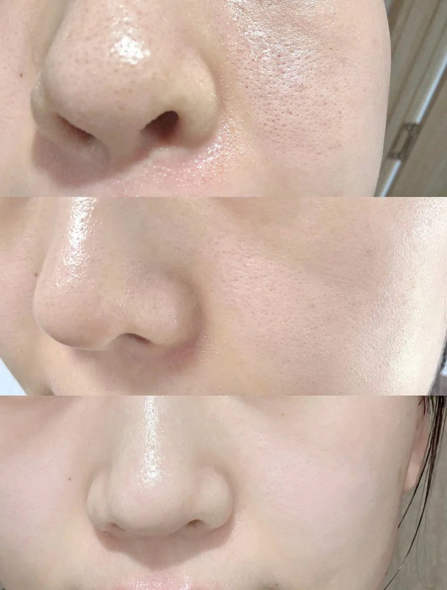 gbbriell1's tweet photo. Dikira pakai m*rkur* gara2 ini 😭 padahal produk ini resep dokter kulitku, kulit jadi halus bgt no komedo no jerawat &amp; cerah tanpa facial👌￼ https://t.co/JNipGRCHvI