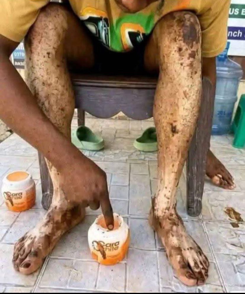 AKO BALEKE tweet media