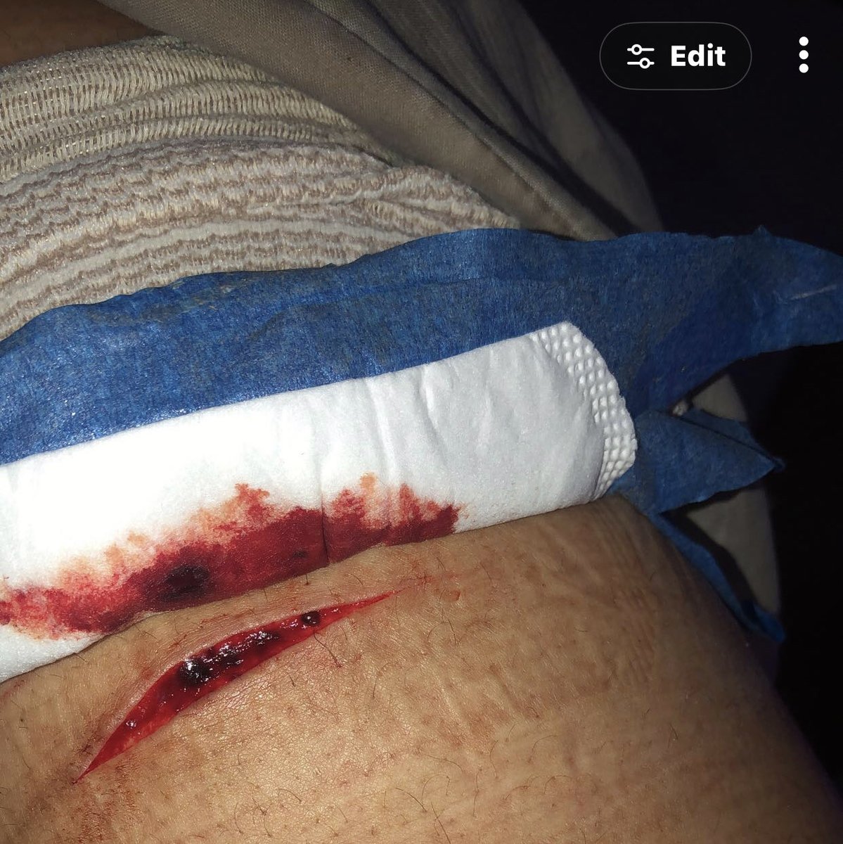 Chrissyluv9736's tweet photo. @pumpkin_gvts I’m honestly unsure how to either I have no clue what to do with this.. if u have any advice it’s still bleeding it’s been 4 hours 😭 https://t.co/P7oEhd492f