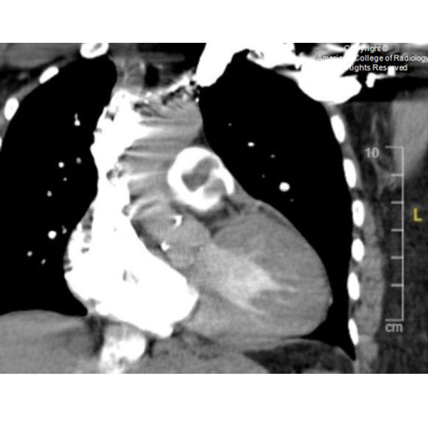 RadiologyACR's tweet photo. An 81-year-old female presents with one week of progressively worsening shortness of breath. #ACRCaseinPoint https://t.co/AflFqFU3n9 https://t.co/4NBVL8fUPI