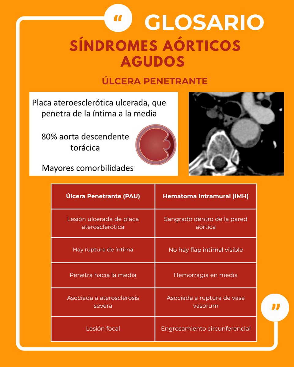 SONECOM_AC's tweet photo. 📘 Glosario SONECOM | Síndromes Aórticos Agudos
Comprenden un grupo de emergencias cardiovasculares que afectan la pared de la aorta y requieren diagnóstico inmediato.
🫀 Incluyen:
▫️ Disección aórtica
▫️ Hematoma intramural
▫️ Úlcera aterosclerótica penetrante
#SONECOM #Glosario https://t.co/UWS7VFoAbu