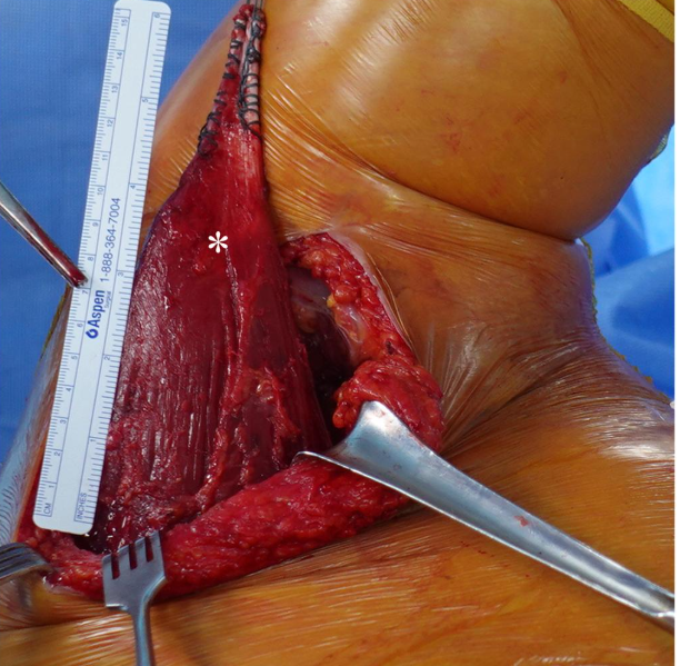 jbjs's tweet photo. "Long-Term Outcomes After Arthroscopically Assisted Latissimus Dorsi Tendon Transfer for Irreparable Posterosuperior Rotator Cuff Tears" by Baek et al.

Read the full article 👉 https://t.co/FrlgSM40Er

#JBJS https://t.co/8XEQyL3gcy