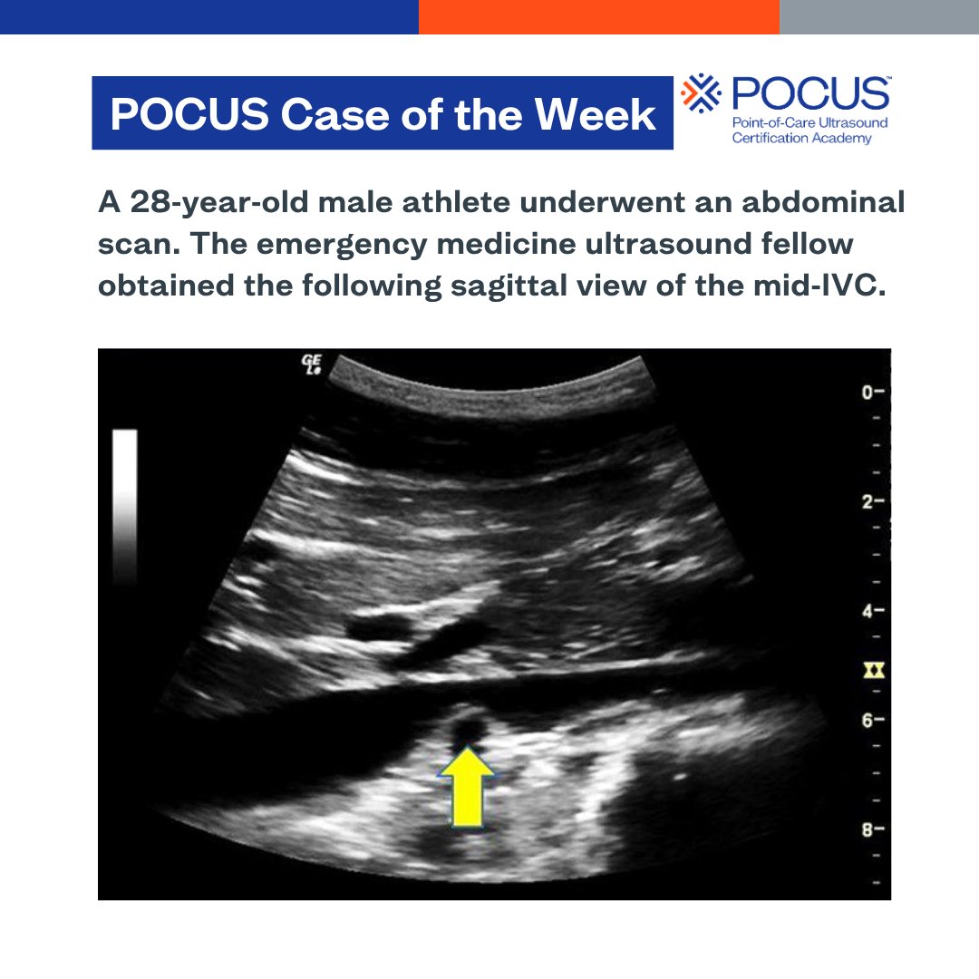 POCUSAcademy's tweet photo. π£ Case of the week!
Let us know your answer in the comments!
#POCUS #POCUSCaseStudyChallenge https://t.co/OCrrhBP18B