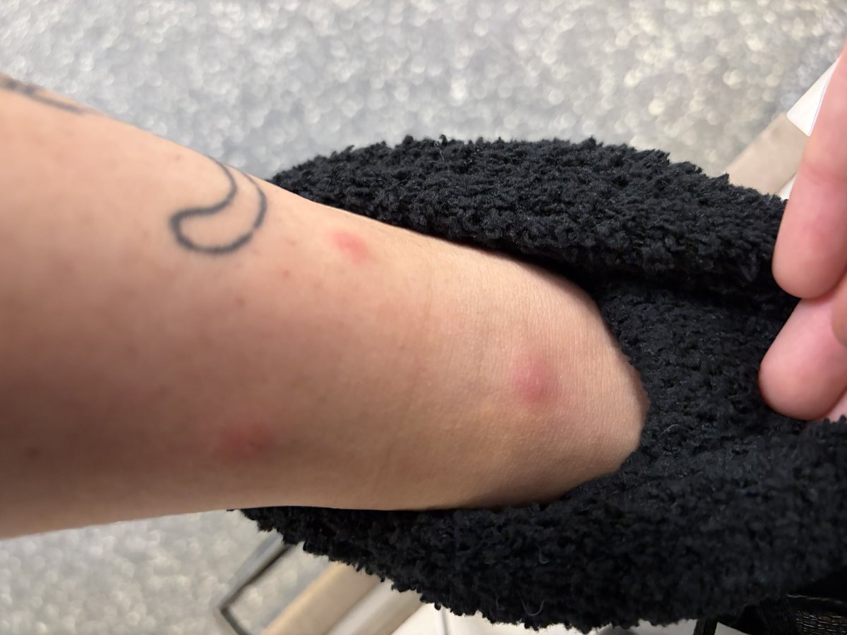 H0110WHEAD's tweet photo. Evidence of Harm  + more on my other leg and on my foootttt dude wthhh https://t.co/Z0fVxldcuE