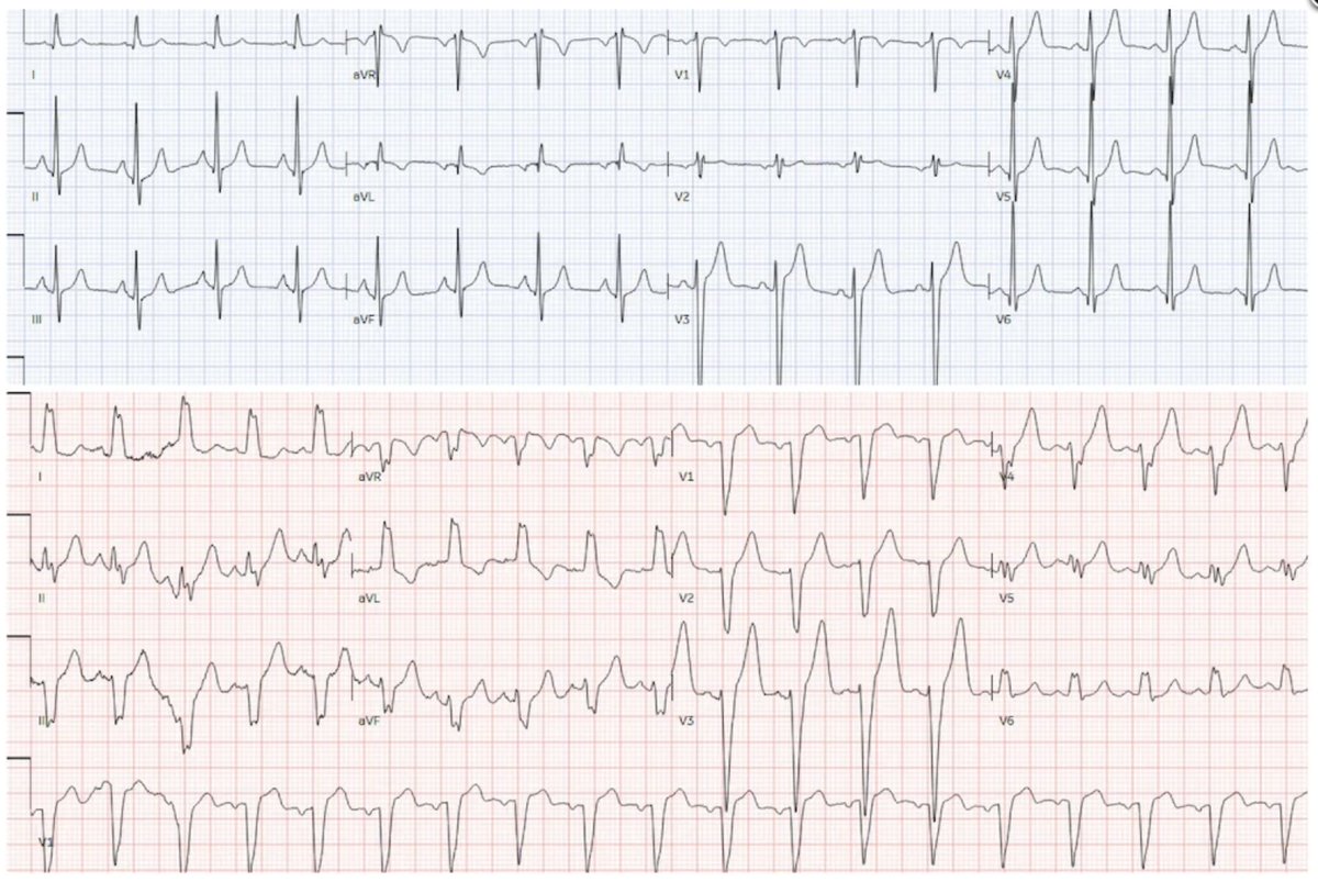 smithECGBlog's tweet photo. 65 year old with chest pain + new Left Bundle Branch Block: is this acute coronary occlusion?

https://t.co/s6G2mnxxl6

@ECGcases 

Old ECG on top.  New on bottom. https://t.co/dEarpXyRz3