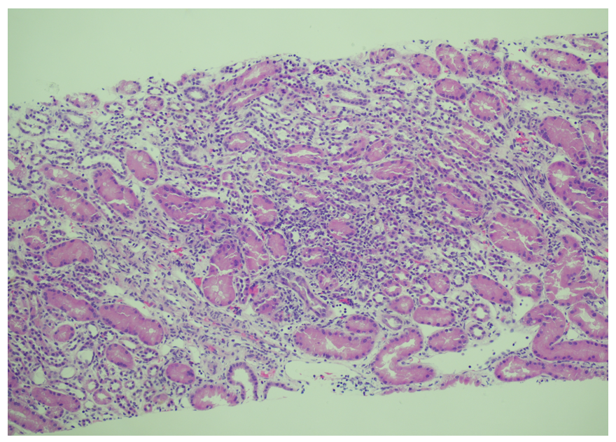 asnpublications's tweet photo. #CaseReport in #ASNKidney360 shows that when minimal change disease (MCD) is refractory, relapsing, or atypical, clinicians should maintain a high index of suspicion for occult malignancy, including Hodgkin’s lymphoma. https://t.co/TwqhGnmQCc https://t.co/aRjbIEebDo