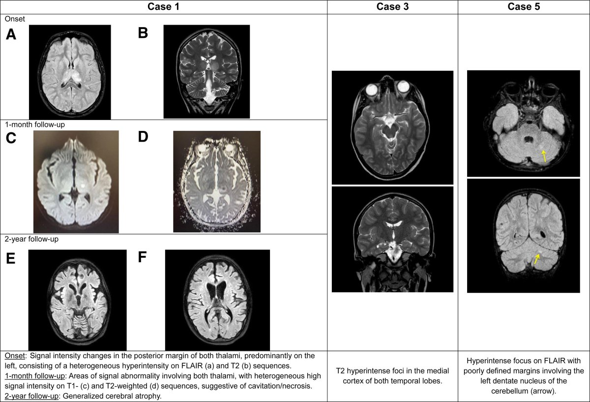 GPI_AEPap's tweet photo. Emergence of Pediatric West Nile Virus Neuroinvasive Disease in Spain: An Expanding Threat in a Changing Climate—A Case Series https://t.co/8A4qkdbPAw a través de @GPI_AEPap https://t.co/qA9fIPiuIA