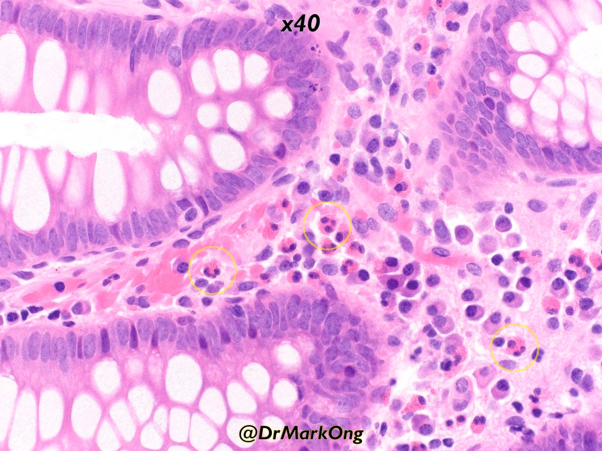 DrMarkOng's tweet photo. Do you sometimes find it difficult to distinguish neutrophils from eosinophils?
To make it even harder, you can get hypersegmented eosinophils to confuse you even more!
Probably of no significance.
(Case of treated ulcerative colitis)
#gipath #pathX #pathology https://t.co/j2UkExhsgg