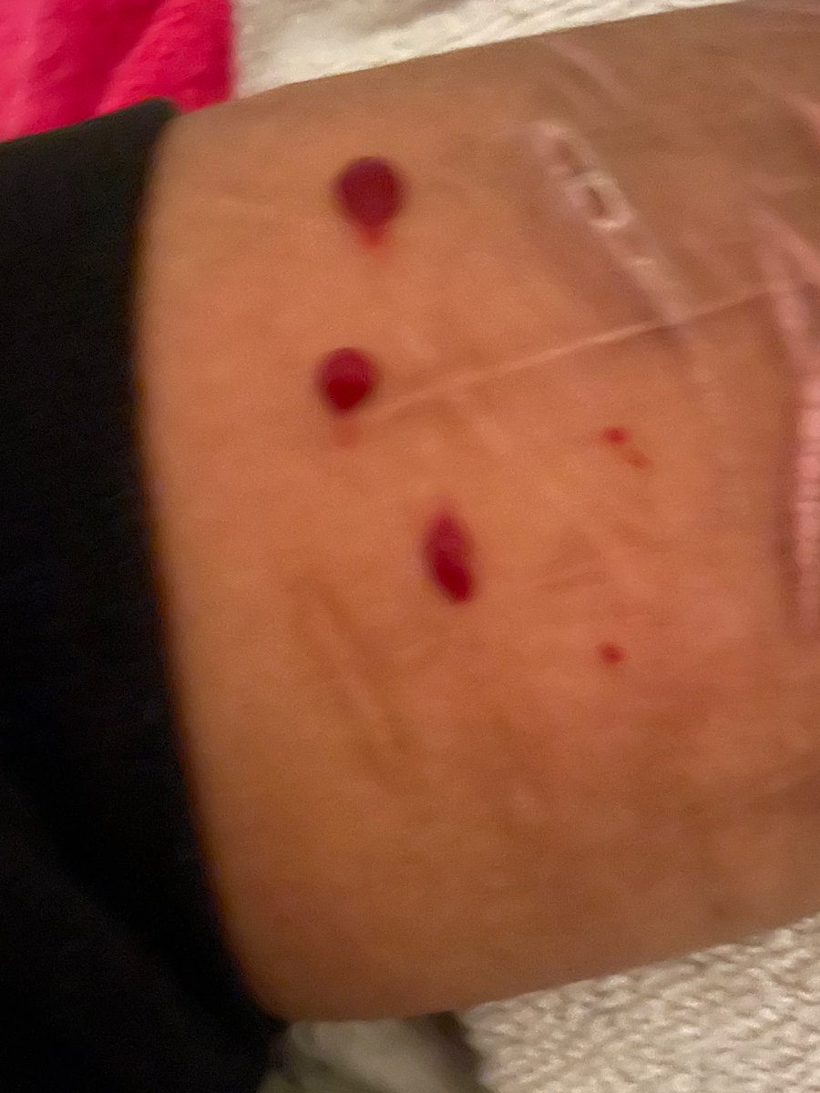 Ahgexr's tweet photo. I don’t really get how I used to cut myself I relapsed and I’m so disappointed it didn’t make me feel better and I lost my 1 and half streak for some cat scratches but I just couldn’t do it any deeper #sh

TW cat scratches https://t.co/L2eIKphYif