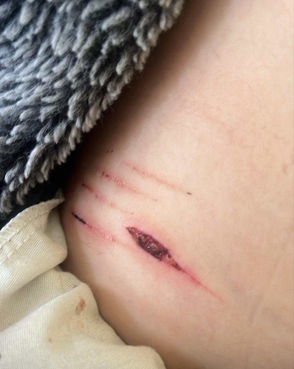 sugubutt's tweet photo. Scabs suck https://t.co/0mraQorb0t