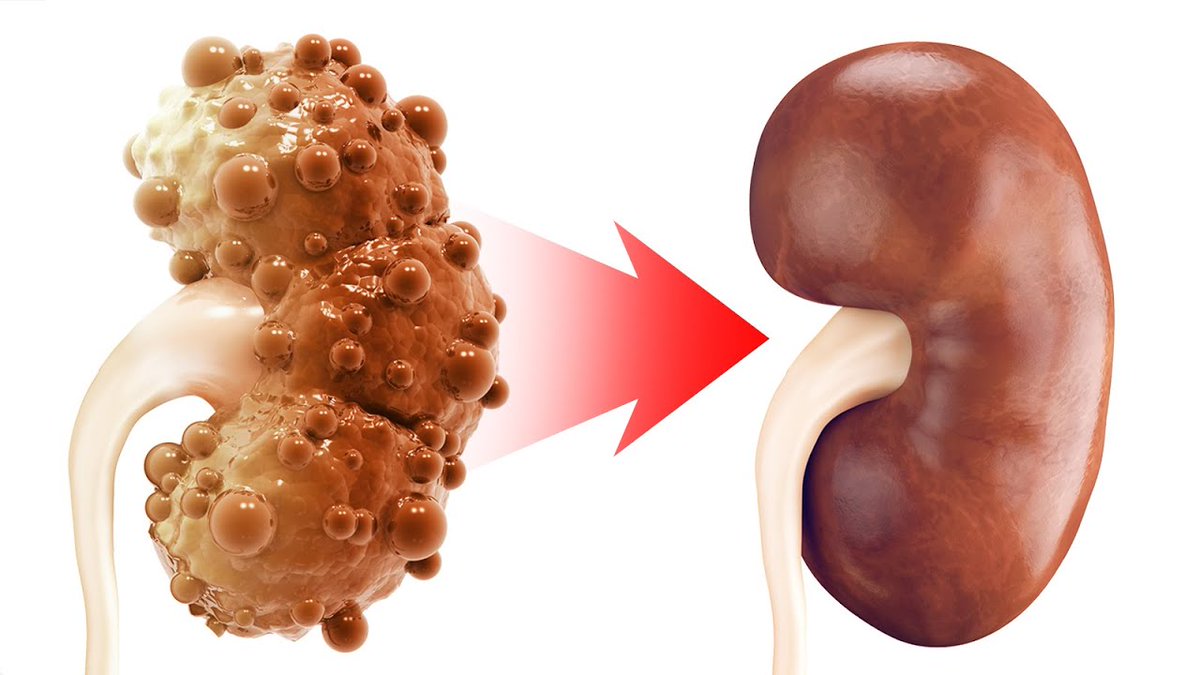 dr_ericberg's tweet photo. Kidney disease may not start where most people think it does.

New research is linking excess glucose and constant eating to changes inside the kidneys long before serious symptoms appear.

The connection between blood sugar and kidney damage is deeper than most people realize.

https://t.co/yLsvTa5pPE

Dr. Eric Berg, DC, not MD; information only