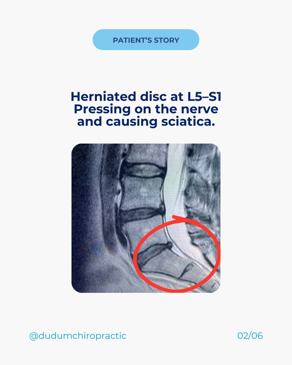 JDchiro's tweet photo. When you’re told surgery is your only option… the MRI may tell a completely different story.

This patient was struggling with severe disc compression, constant pain, and limited movement. After targeted spinal decompression, the pressure on the nerves was reduced, without surgery.

Sometimes the problem isn’t permanent damage.
It’s pressure.

DM “MRI” if you want to find the real cause of your pain.

#spinaldecompression #herniateddisc #backpainrelief #sciatica #mri #spinalhealth