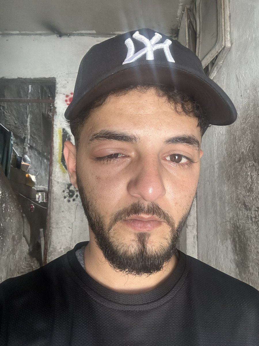 yazanomarrr's tweet photo. I beg you, please help me before I lose my eye.🥹🙏

I woke up today with my eye severely swollen and I’m struggling to get the medical treatment I urgently need. The pain and fear are overwhelming, and right now I truly need support from kind people.

If anyone can help with even a small donation or by sharing this post, it would mean the world to me. Every bit of help brings me closer to getting treatment and protecting my vision. ❤️🙏

https://t.co/yQsnBeJgWN