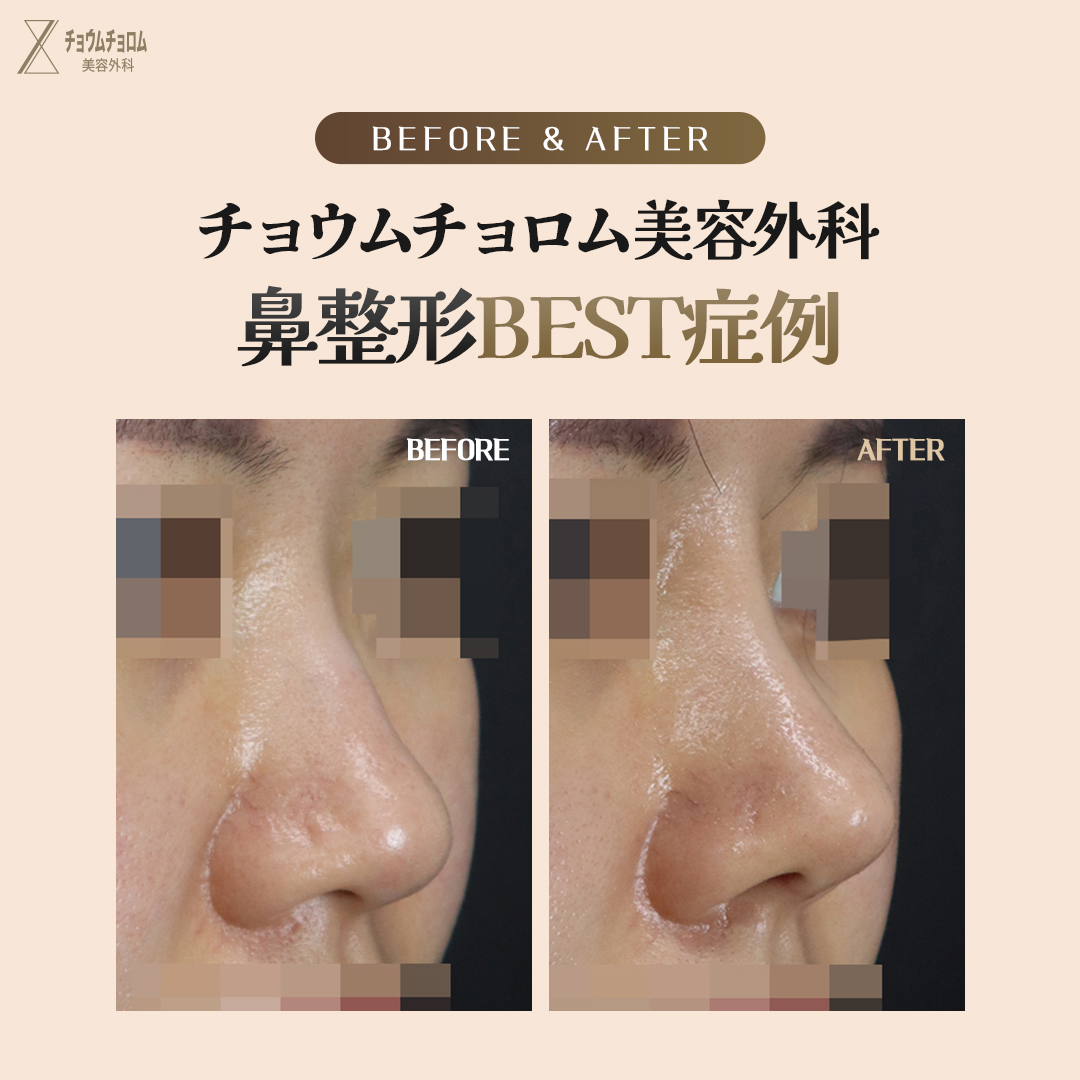 likefirst_jp's tweet photo. チョウムチョロムが教える
#整形手術 Before&After

目、鼻手術はすべて自信あります。
チョウムチョロム美容外科では’工場式’のような画一的な手術は行いません。
患者の目、鼻の形と年齢、シーズンなどの状態に合わせて
1：1パーソナライズで安全に手術を行う事をお約束します。
カウンセリングから手術、後管理まで代表院長1：1責任制で全ての過程を担当し、
嘘のない診療を行います。

#チョウムチョロム美容整形外科　#目整形　#鼻整形
#代表院長パーソナライズカウンセリング無料
#江南駅

#チョウムチョロム美容整形外科 #鼻整形 #小鼻縮小 #ナチュラル #鼻整形 #鼻再手術 #拘縮鼻 #韓国整形 #鼻中隔延長 #鼻鏧形レポ #鼻先 #鼻形 #美容整形 #形 #軟骨移植 #鼻整形レビュー #プチ軽形 #中年整形 #美意識 #美容オタク #美容整形外科 #形メイク #鼻尖形成 #軟骨移植 #鼻整形レポ #整形レポ #美容整形 #美容外科 #美容整形外科 #韓国ビューティー