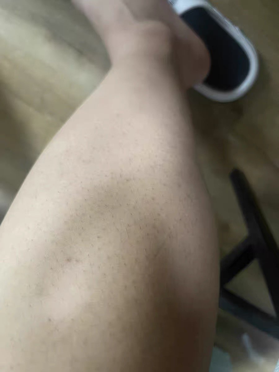 xynruirui's tweet photo. 本来想找脱毛之前毛发旺盛的照片对比来着，但是时间太久了，好几年了都，只找到了刚脱毛时的照片，将就用吧，主要是想通过对比，来告诉一些穿女装的小CD，穿女装，尤其是穿丝袜，脱毛环节是必不可少的，前面几张分别是刚开始脱毛和脱毛不久的照片，而最后两张是我刚才拍的左右小腿的照片，效果显而易见 https://t.co/0gXqV8Ehor
