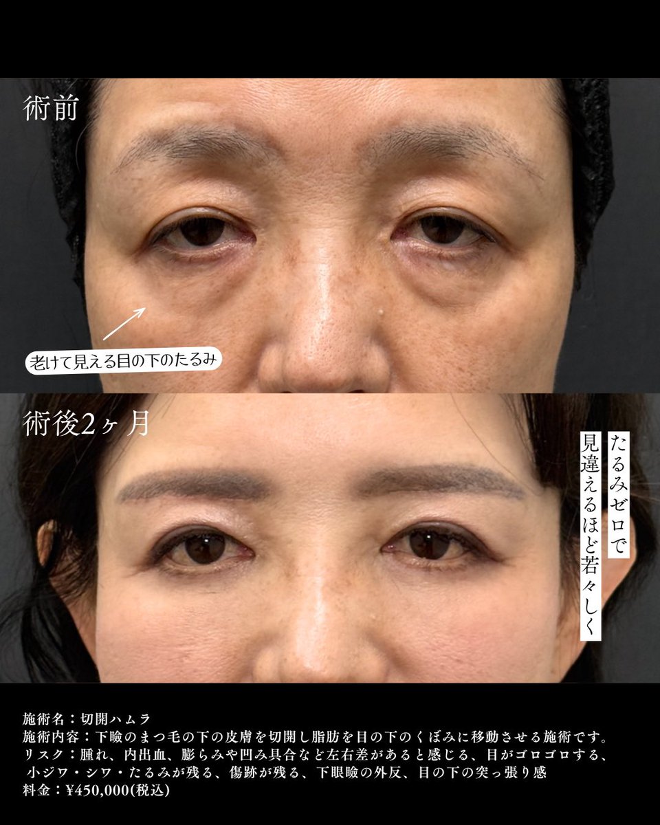 ApollonClinic's tweet photo. ドクターわだまりの若返り施術！✨
マイナス10歳も夢じゃない���
「歳だから」と諦める必要はありません
お気軽に無料相談へ💕 https://t.co/xxwLtibR3i