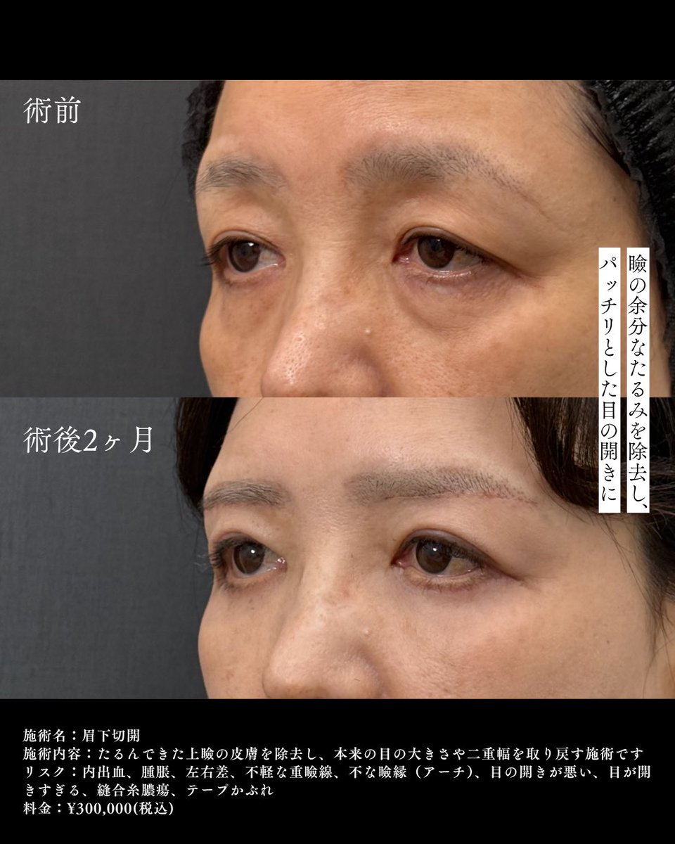 ApollonClinic's tweet photo. ドクターわだまりの若返り施術！✨
マイナス10歳も夢じゃない���
「歳だから」と諦める必要はありません
お気軽に無料相談へ💕 https://t.co/xxwLtibR3i