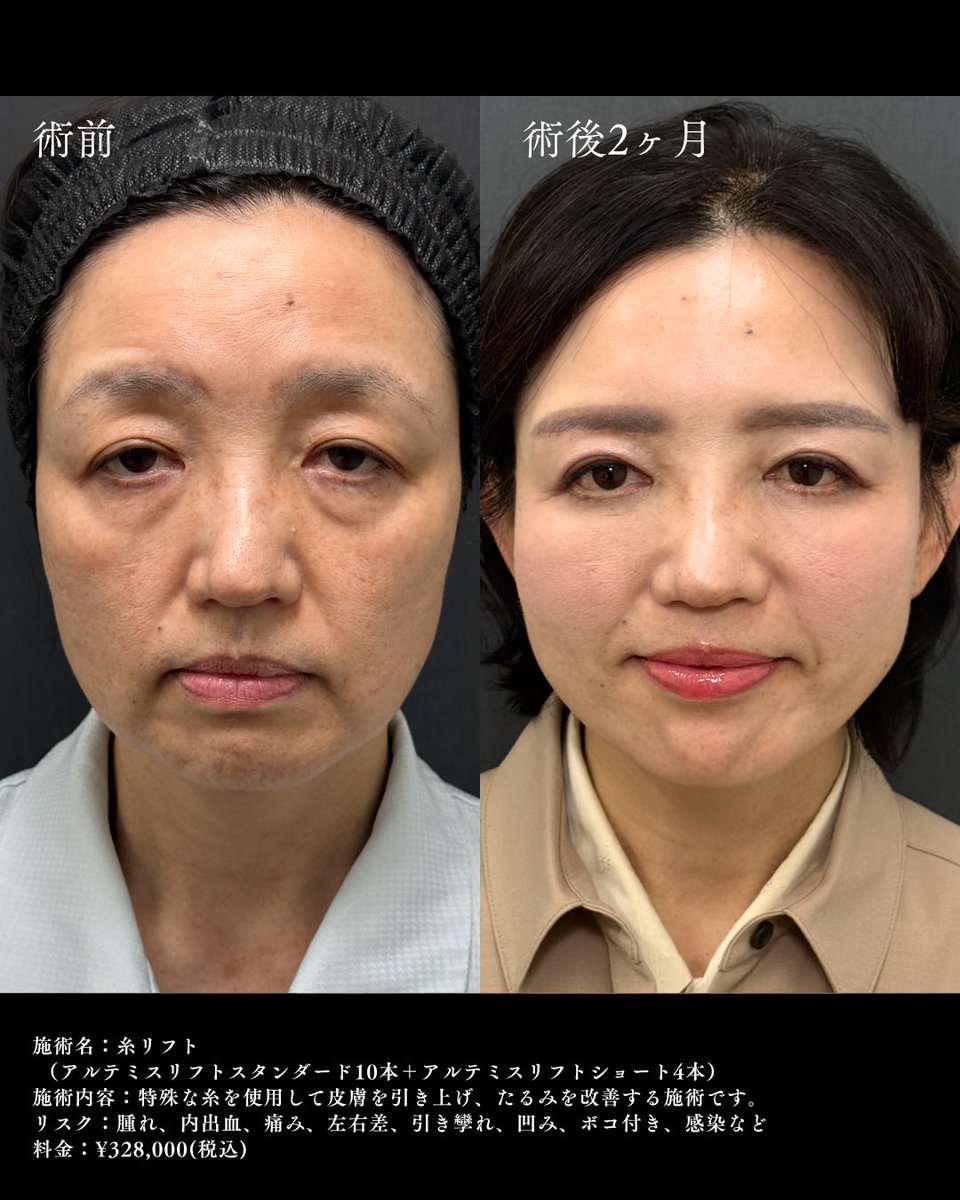 ApollonClinic's tweet photo. ドクターわだまりの若返り施術！✨
マイナス10歳も夢じゃない���
「歳だから」と諦める必要はありません
お気軽に無料相談へ💕 https://t.co/xxwLtibR3i