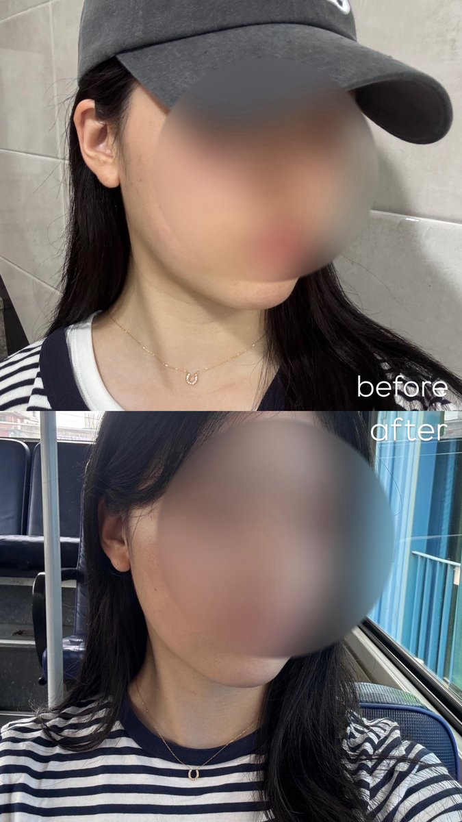 oimochan222's tweet photo. 江南にあるBarog Clinicでオンダリフトと鎮静管理を受けて来ました！
受付してから肌診断をしてカウンセリング、施術へ！
カウンセリングにて肌診断結果を見ながら今の肌の状態やおすすめの施術などを見てもらいました！(アップセルなし)
スタッフさんがとても丁寧で大満足🤍 https://t.co/bGp9p1SR7E