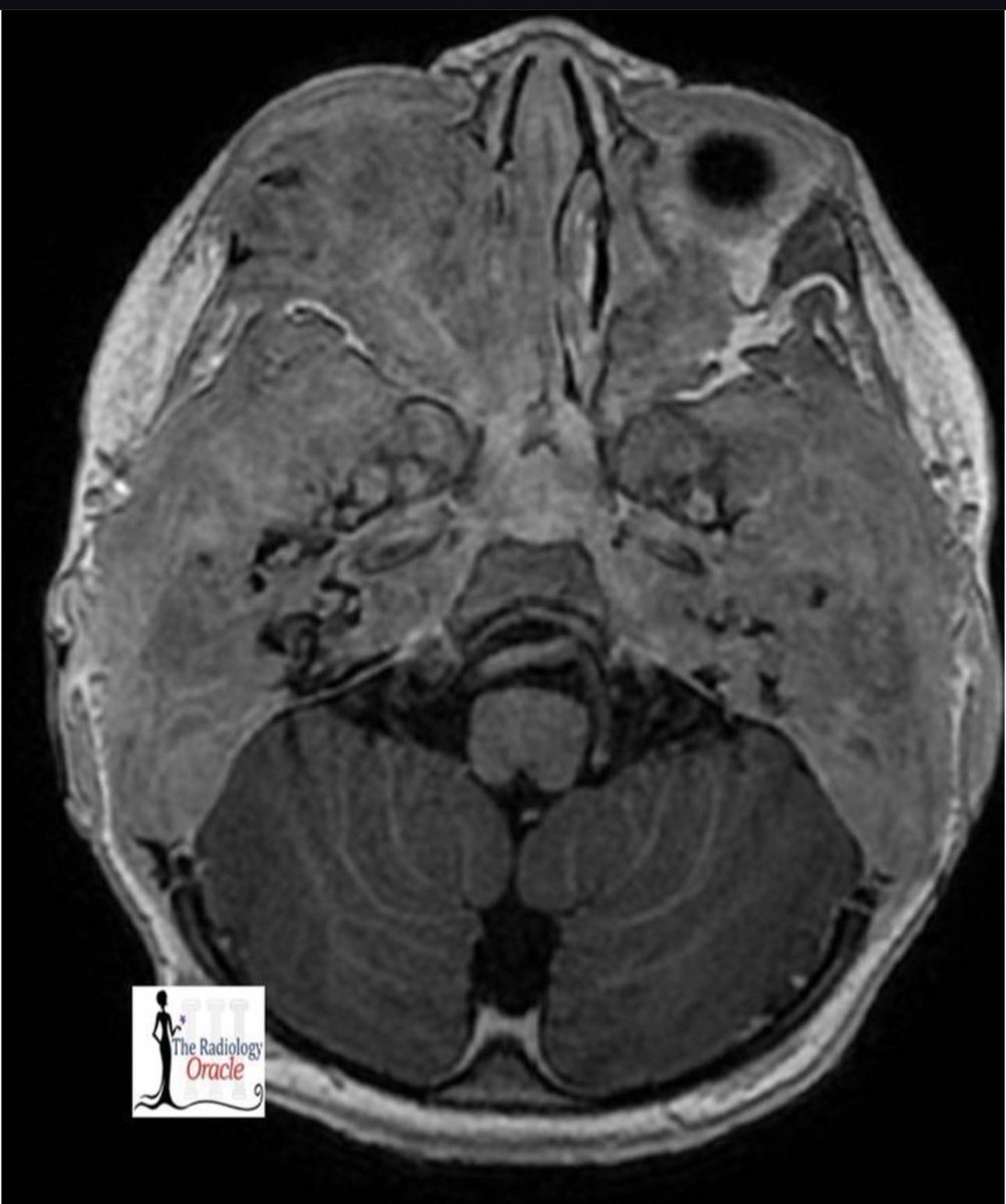 TheRadOracle's tweet photo. 18-month-old boy with bilateral post-auricular swelling 👶🦴

Clinical presentation:
🔹 Otorrhea with mastoiditis
🔹 Poor response to sounds
🔹 Gradual hearing loss reported by parents

#FOAMRad 
#MedEd 

@_the_SRT @ESHNRSociety @spinacademics https://t.co/gW2SCdfeA2