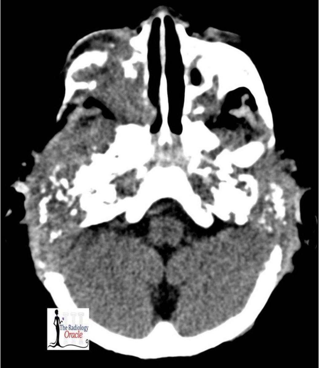 TheRadOracle's tweet photo. 18-month-old boy with bilateral post-auricular swelling 👶🦴

Clinical presentation:
🔹 Otorrhea with mastoiditis
🔹 Poor response to sounds
🔹 Gradual hearing loss reported by parents

#FOAMRad 
#MedEd 

@_the_SRT @ESHNRSociety @spinacademics https://t.co/gW2SCdfeA2