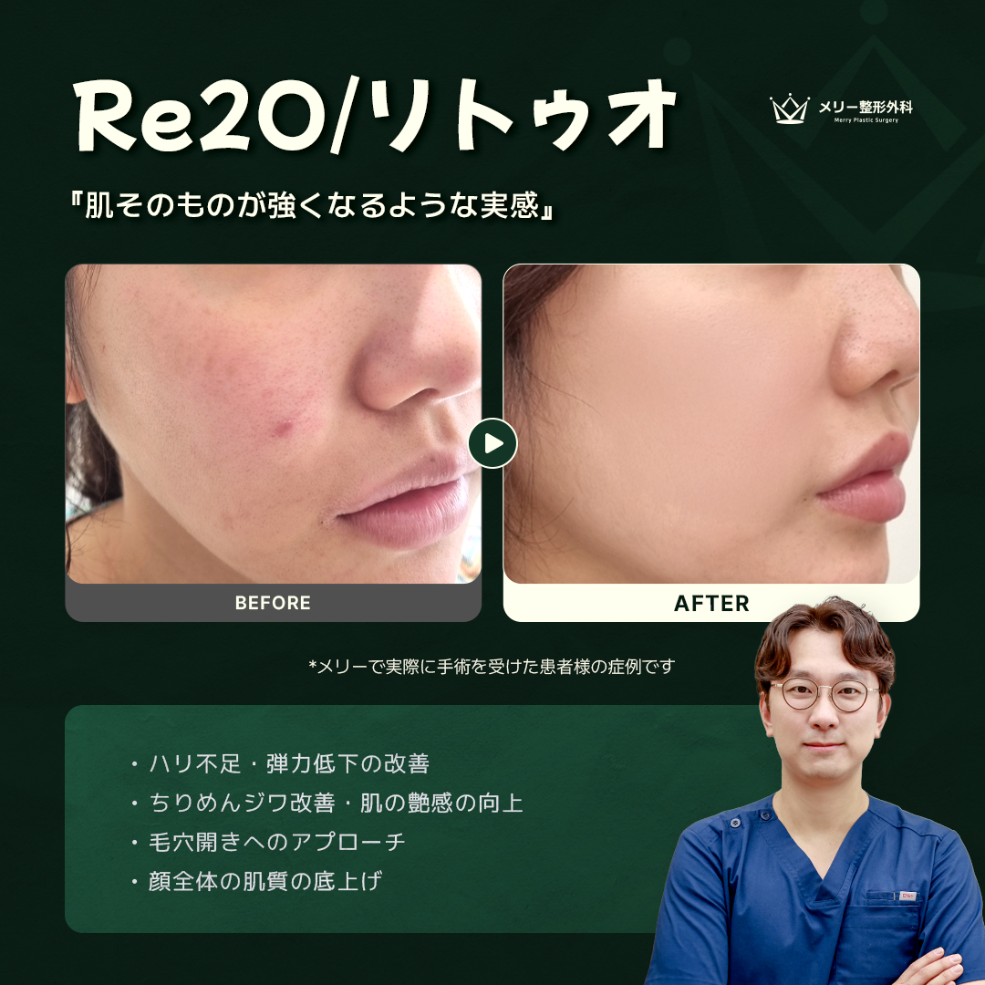 Merryps_jp's tweet photo. ＼肌そのものが強くなる実感を✨／

土台から整える合理的スキンブースター
エラビエ『Re20/リトゥォ』

赤み・毛穴・小じわを改善し、
肌全体のクオリティを底上げします。💖

🏥ご予約は公式LINEまで
 https://t.co/6sV5vOFwAR

#韓国整形 #渡韓整形 #リトゥオ #肌育 #メリー整形外科 https://t.co/nSLc0Am0hI